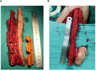 The fusiform skin paddle in fibula free flap: a fusiform-designed skin paddle for maxillofacial soft defect reconstruction and reducing leg wound tension